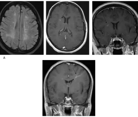 Figure 1. Developmental venous anomaly (DVA) in a patient with multiple sclerosis (MS)