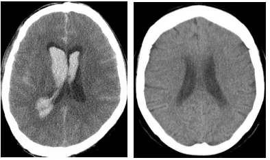 Figure 2. Abnormal and normal brain CT images. 