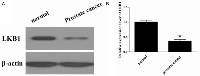 Figure 1. LKB1 protein expression level in prostate cancer tissue. LKB1 expression in the normal tissues and prostate cancer tissue was detected by Western blot assay
