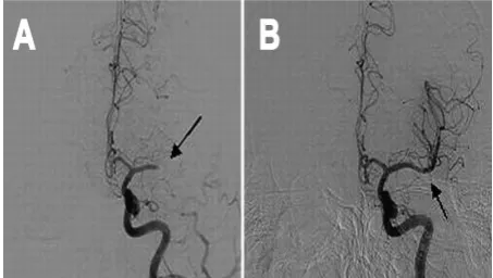 Figure 1. A: Grade 0: No Perfusion, and B: Complete perfusion of left middle cerebral artery (MCA) occlusion followed by reperfusion of recombinant tissue plasminogen activator (rtPA) 