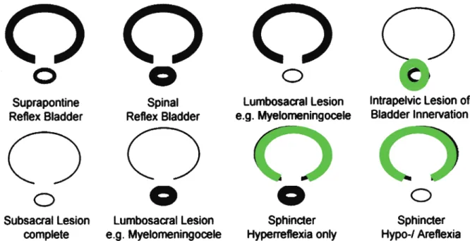 Figure 3. Patterns of neurogenic detrusor-sphincter dysfunction Heavy lines symbolize hyperreflexia, thin lines hypo- or areflexia and green lines a normal innervation of the relevant structure, for futher explanation see text.