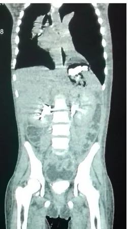 Figure 1. Standard thoracoabdominal radiograph show-ing left pneumothorax with intra-thoracic aerocoly