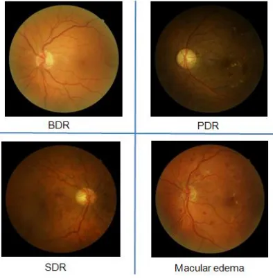 Fig 3 Unhealthy eye patterns 