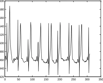 Fig 17. QRS detection at third level using Sym10 in record f1y04 of Fantasia database