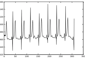 Fig 21. QRS detection at third level using wavelet designed by algorithm given by Chapa et al