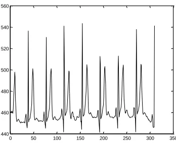 Fig 35. Third level decomposition using Sym10 in record f1o06 of Fantasia database. 
