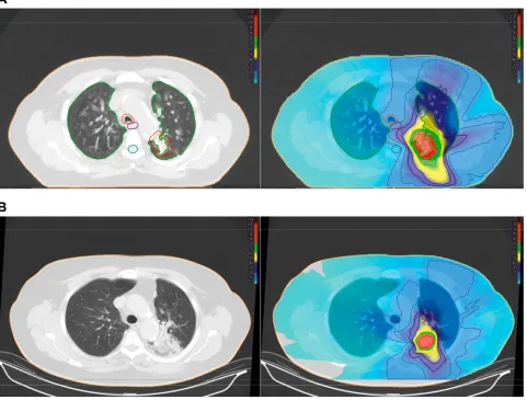Figure 2 Radiation pneumonitis after SBRT. (A left): 78 years old female patient with histologically proven non-small cell lung carcinoma (within the red contour)