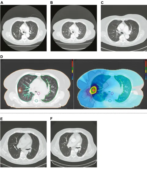 Figure 4 Local control after SBRT. (A–D): (A): 86-year-old woman with a metachronous (5 mm) lung metastasis of colon carcinoma (white arrow)