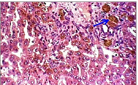 Fig. 4. Hepatocyte degeneration (ballon) (H&E 40x).             