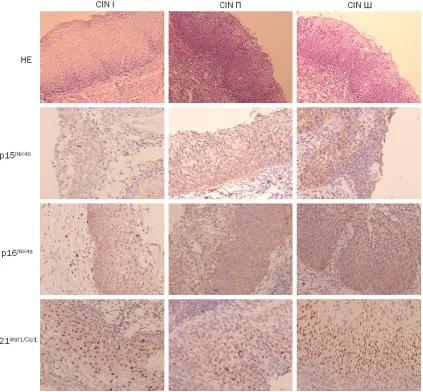 Figure 2. Expression of OIS markers in CIN І, CIN П and CIN Ш (magnification × 200).