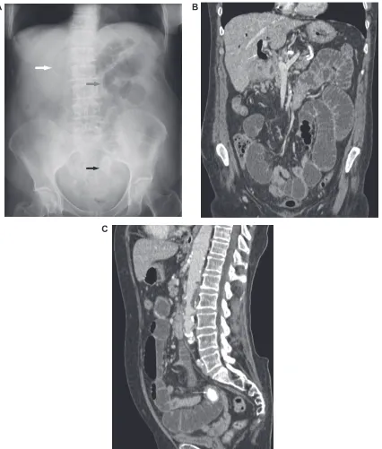 Figure 10 eighty-three-year-old woman with a history of abdominal pain and vomiting. A) Plain abdominal radiograph demonstrating air in the biliary tree (white arrow), dilated loops of small bowel (grey arrow), and a calcified gallstone projected over the 