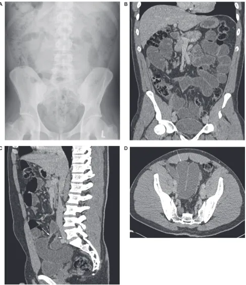 Figure 1 Thirty-two-year-old man presenting with vomiting, abdominal pain, and guarding postappendectomy