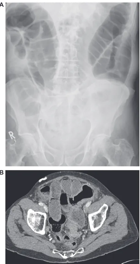Figure 4 Eighty-five-year-old man presenting with a 2-week history of constipation, abdominal distension, and pain