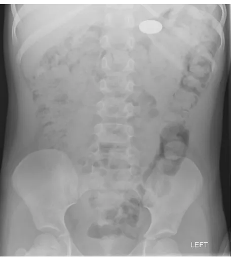 Figure 6 Plain abdominal radiograph of a 5-year-old boy who had ingested a coin battery