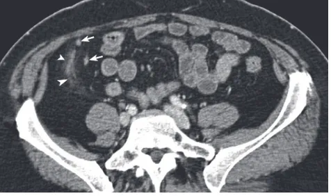 Figure 7 A 49-year-old male suspected for appendicitis. Computed tomography (CT) after iv contrast medium shows a thickened appendix (arrow) with a thickened appendiceal wall, inﬁ ltration of the adjacent fat (arrowheads) and a thickened fat plane (curved 