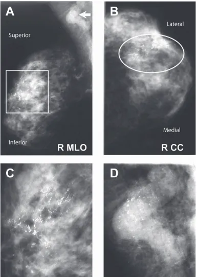 Figure 1 Right breast mammogram pre-treatment. Suspicious calciﬁ cations are seen in the right upper outer breast on A) mediolateral-oblique (MLO; rectangle) and B) craniocaudal (CC; oval) views