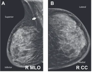 Figure 2 Right breast magnetic resonance imaging pre-treatment. Three-dimensional maximal intensity projection reformat of the right breast images in A) inferior–superior and B) mediolateral projections