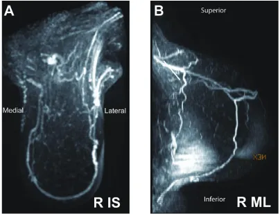 Figure 4 Right breast magnetic resonance imaging post-treatment. Three-dimensional maximal intensity projection reformat of the right breast images in A) inferior-superior and B) mediolateral projections