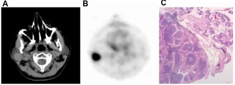 Figure 2 Transverse contrast-enhanced CT (A) and F-18 FDG PET (B) images of a right parotid mass with intense F-18 FDG uptake