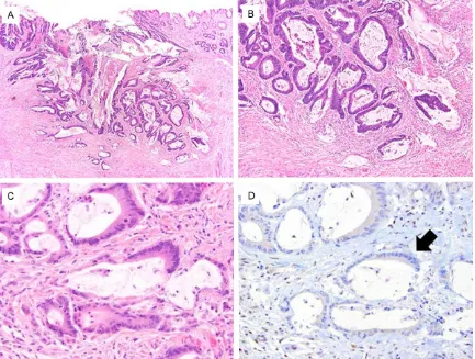 Figure 5. The patient’s second colon cancer was diagnosed when the patient was 52 years of age and consistent with (A and B) an invasive moderately-differentiated mucinous adenocarcinoma arising in association with a tubular adenoma.