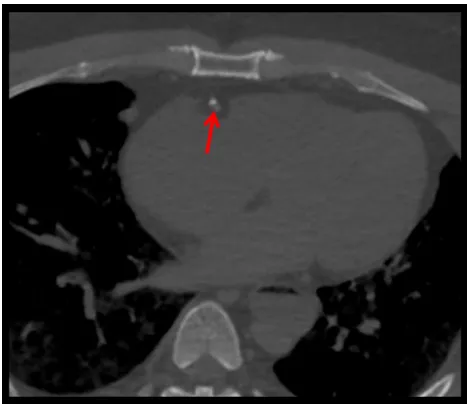 Figure 3 Visualization of a calcified plaque on the middle part of the right coronary artery (red arrow) in a 2D axial PMCT-based reconstruction.Note: No information concerning the patency of the vessel’s lumen can be obtained.Abbreviation: PMCT, post-mortem computed tomography.