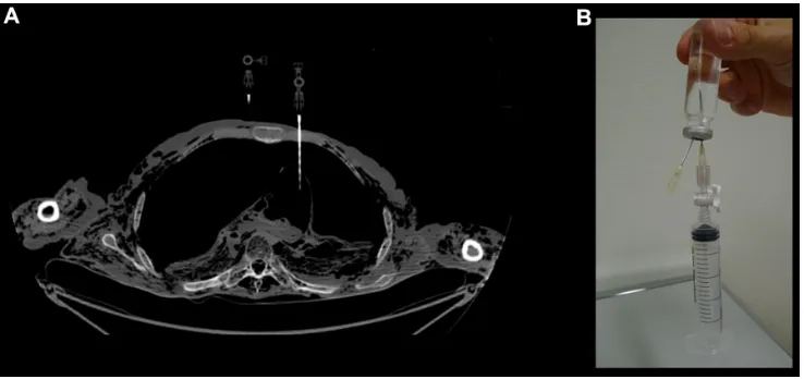 Figure 4 PMCT-guided sampling of gas.Notes: visualization of (A) the sampling of intra-pericardial gas and (B) injection of the collected gas into an ampoule for detailed analysis of a body with massive gas collections (a putrefied body)