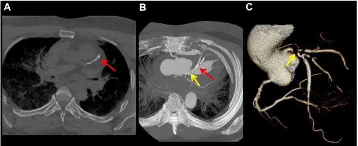 Figure 5 images obtained from the arterial phase of MPMCTA in a case of sudden death of a person known to have a long history of coronaropathy and a coronary stent.Notes: visualization of an intra-stent calcification (red arrow) on the left anterior descen
