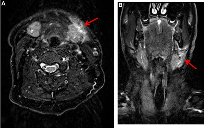 Figure 6 MRi of a victim who survived strangulation (∼1 day after the aggression) in order to examine the profound structure of the neck.Note: visualization of a trauma-based soft-tissue edema (red arrow) in the left submandibular region on (A) a T2 axial view and (B) a T2 coronal view.Abbreviation: MRi, magnetic resonance imaging.