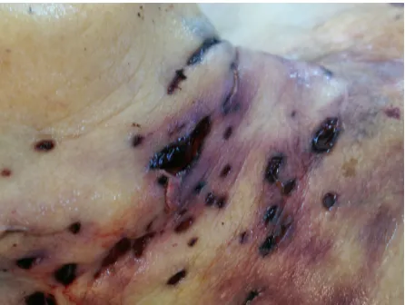 Figure 3 Multiple bite marks on the neck of an 85-year-old woman in a fatal pit bull attack.Notes: The daughter of the victim indicated that the dog was provoked previously by the victim