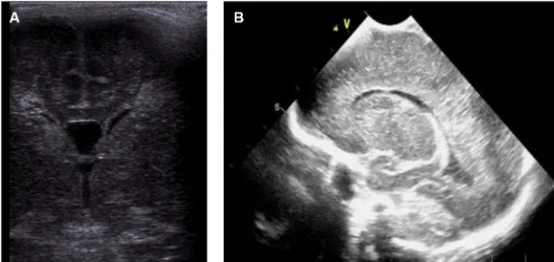 Figure 2 (A, B) Grade I: transient periventricular echodensities persisting for >7 days.