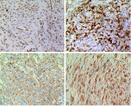 Figure 3. Immunostaining: A. FLi-1 (×200); B. CD31 (×200); C. CK (×200); D. CK18 (×200).