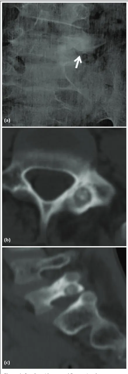 Figure 1a,b,c: Osteoid osteoma L5 posterior element. 