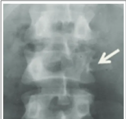 Figure 2c: Dense right pedicle of L2 with absence of left pedicle.