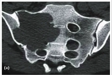 Figure 6a: CT – Giant cell tumor of sacrum. 