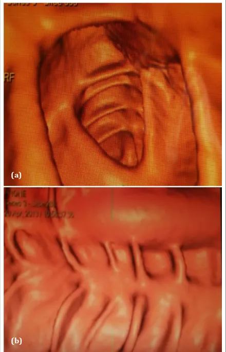 Figure 1: (a) Axial view of CT colonoscopy shows normal haustral folds and mucosal surface; (b) Longitudinal palette view of CT colonoscopy demonstrates spread out lumen.