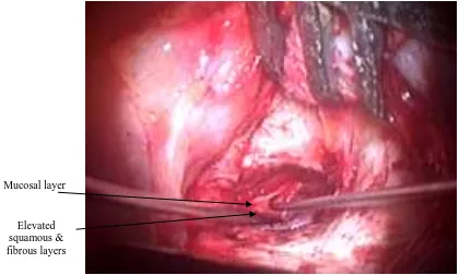 Figure 1.  A; Refreshment of the perforation edge, B; Preoperative tympanic membrane perforation, C; Canal wall incision, D; Tympanomeatal flap elevation  