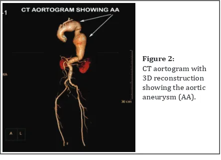 Figure 3: CT aortogram showing the descending thoracic AA impending rupture.