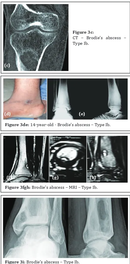 Figure 3c:CT – Brodie’s abscess – 