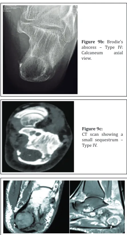 Figure 9d: Brodie’s abscess – Type IVc: MRI shows broken cortex and extension to the soft tissues