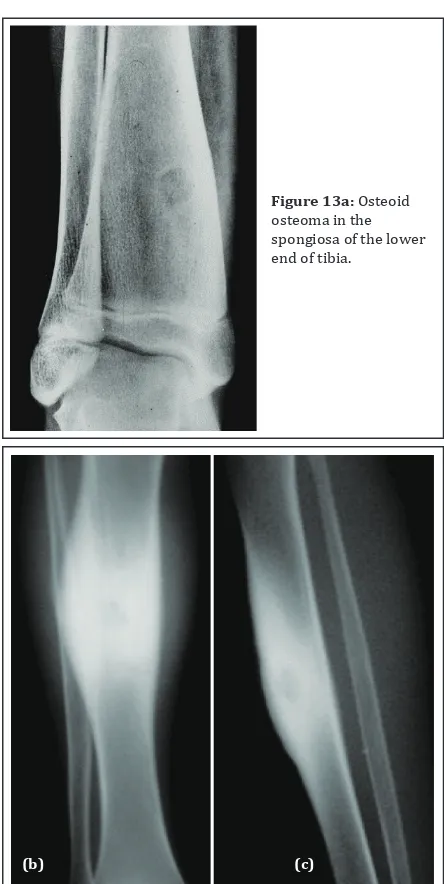 Figure 13a: Osteoid 