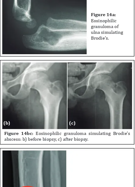 Figure 14bc: Eosinophilic granuloma simulating Brodie’s abscess: b) before biopsy, c) after biopsy
