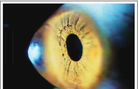 Figure 2: A case of severe allergy which can predispose to keratoconus.