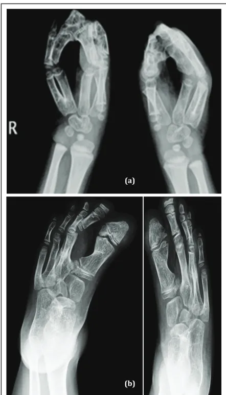 Figure 2: Radiographs of both hands and feet. a) Second to fourth digits and fourth and fifth metacarpals are fused