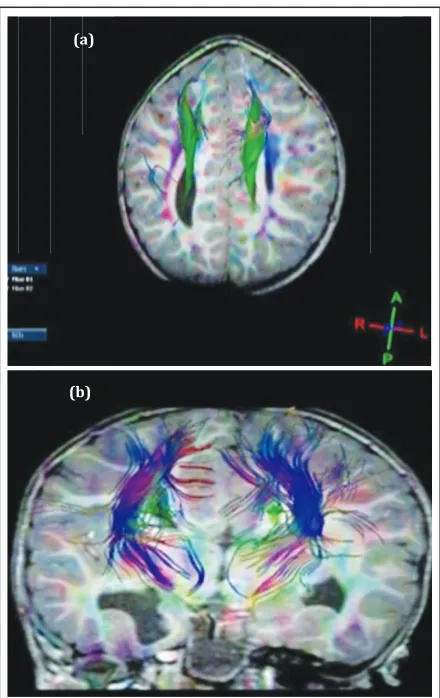 Figure 6: Diffusion tensor imaging with fibre tractography. a) Axial image showing Probst bundle (green)
