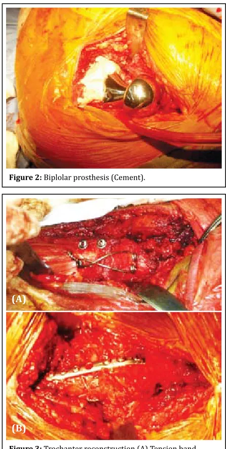 Figure 2: Biplolar prosthesis (Cement).