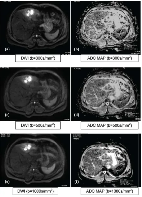 Figure 5 abcdef: AbscessAbbreviations: DWI: Hyperintese, ADC MAP: Hypointense, T1: Hypointense, T2: Hyperintense