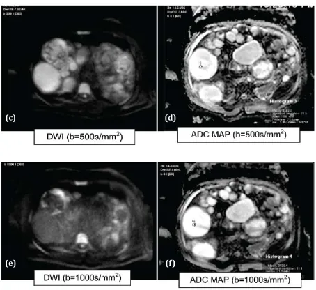Figure 1abcdef: Hydatid cysts  