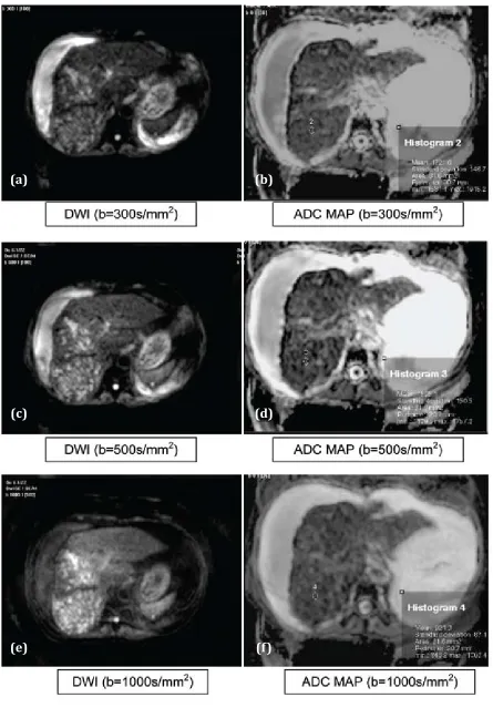 Figure 3 abcdef: Hepatocellular carcinomaAbbreviations: DWI: Hyperintese, ADC MAP: Hypointense,  T1: Hypointense, T2: Hyperintense