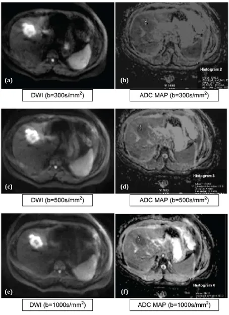 Figure 4 abcdef: MetastasisAbbreviations: DWI: Hyperintese, ADC MAP: Hypointense (Showing persistence of restricted signal intensity on DWI even at higher “b” 