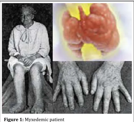 Figure 1: Myxedemic patient